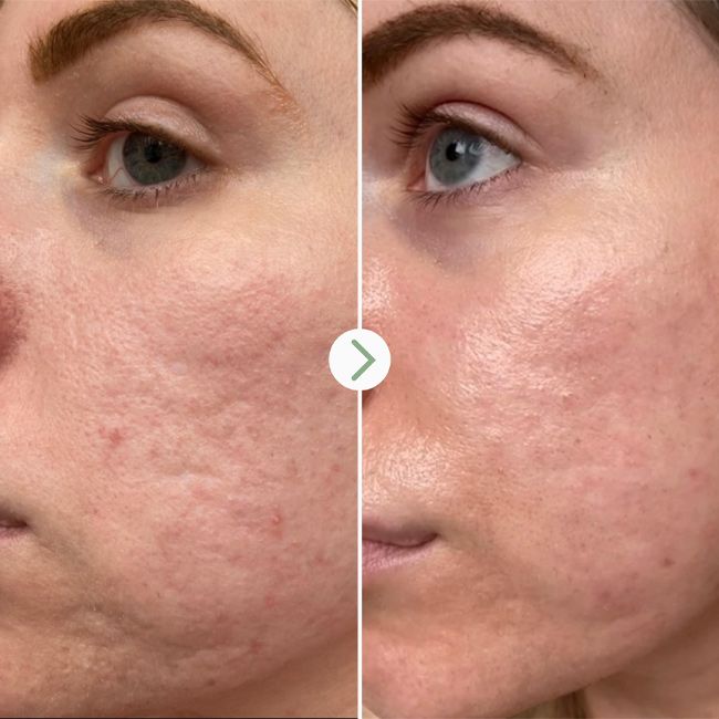 Pai Skincare's natural acide hyaluronique booster Results