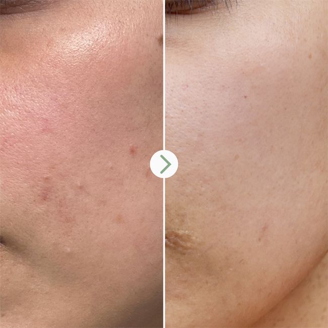 Pai Skincare's Tri-Mushroom Super Soothing Booster Results