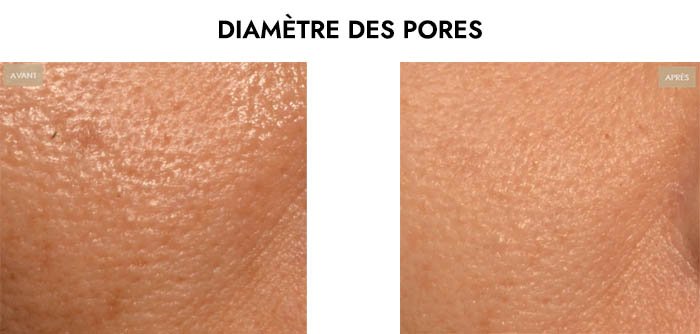 Masque LED Avant Après Pores Dilatés